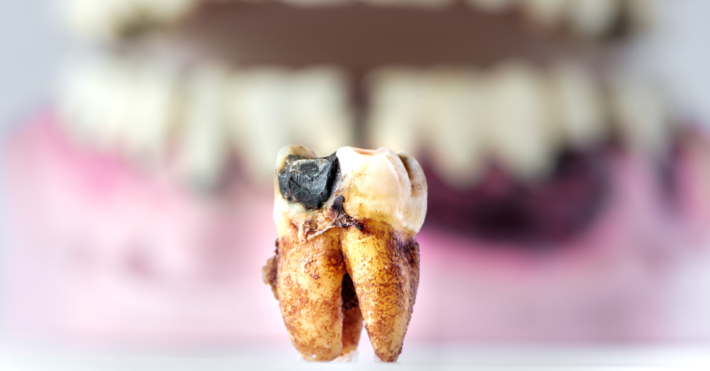 Caries : Les Erreurs que Tout le Monde Fait (et Comment les Éviter) !